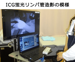 ICG蛍光リンパ管造影の模様