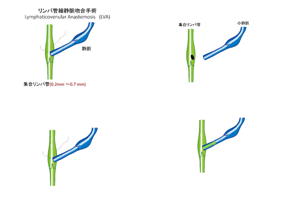 Method of lymphatic anastomosis surgery