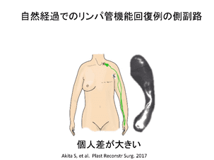 自然経過でのリンパ管機能回復例の側副路
