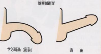 先天性陰茎彎曲症の術前と術後