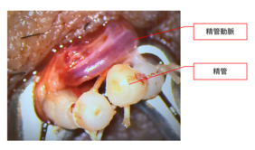手術後の精管の画像