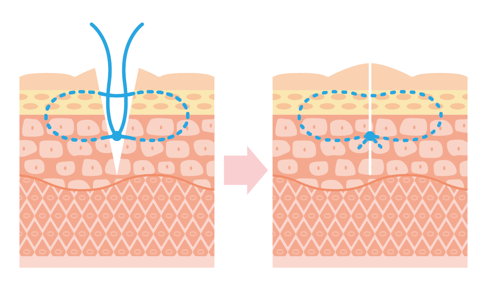 当院の手術は真皮縫合で実施