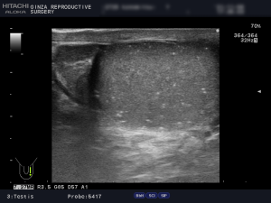 精索静脈瘤エコー検査_石灰化_左側