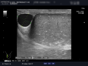 精索静脈瘤エコー検査_石灰化_右側