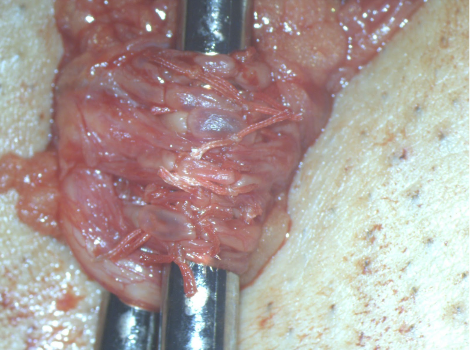 精索静脈瘤手術手順