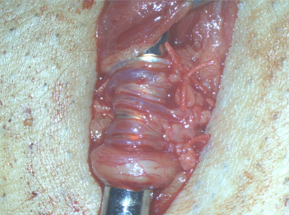 精索静脈瘤手術手順