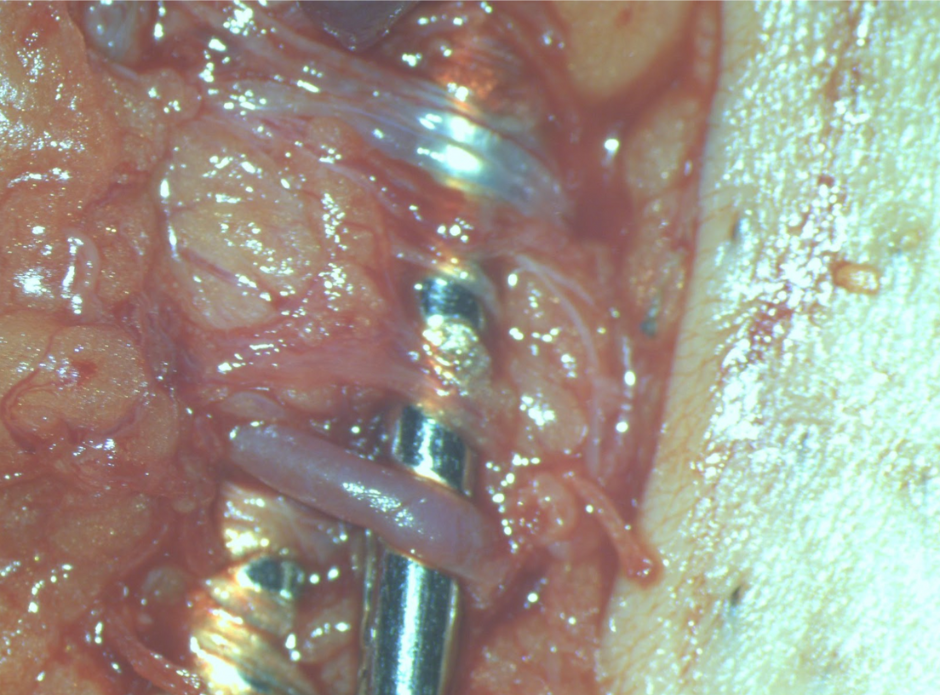 精索静脈瘤手術手順