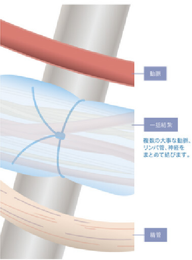 一括結紮による精索静脈瘤手術イメージ