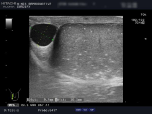 例2：左右の精巣のエコー画像　右側