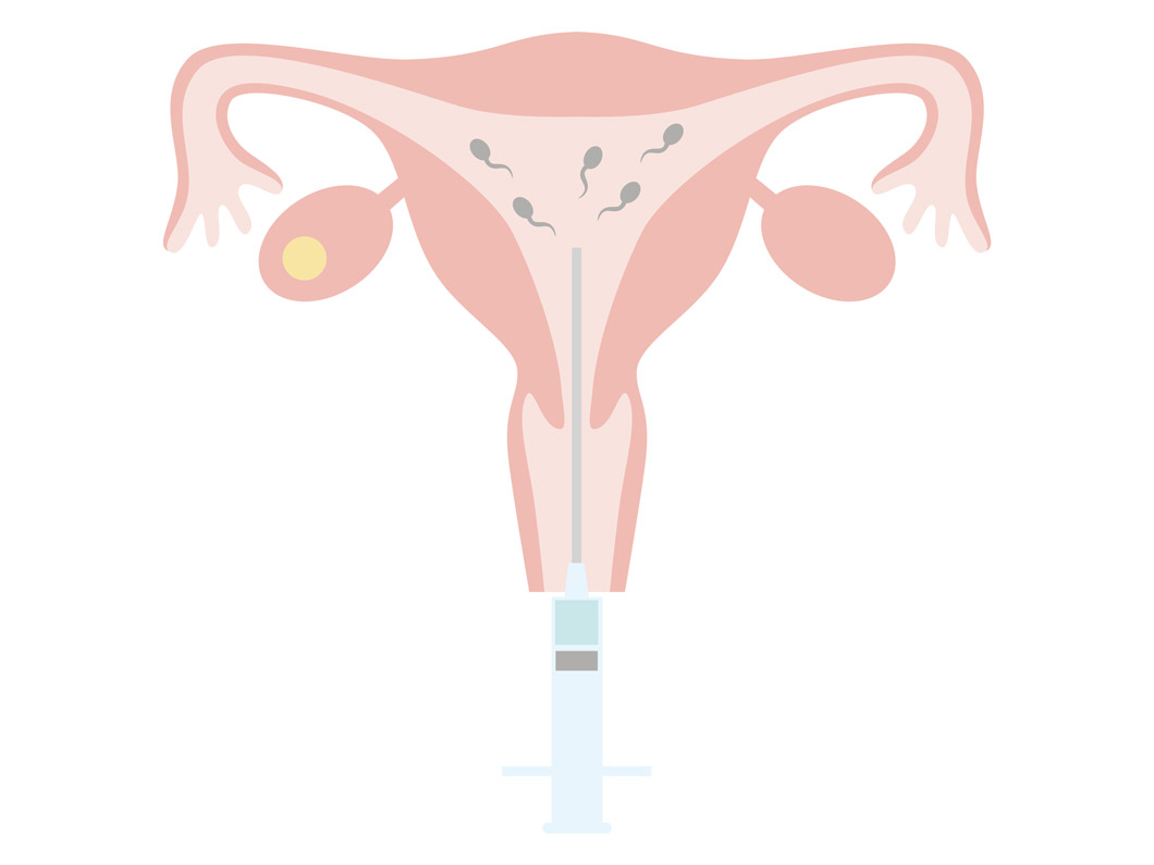 人工授精とは？流れや費用、妊娠確率、副作用などを解説