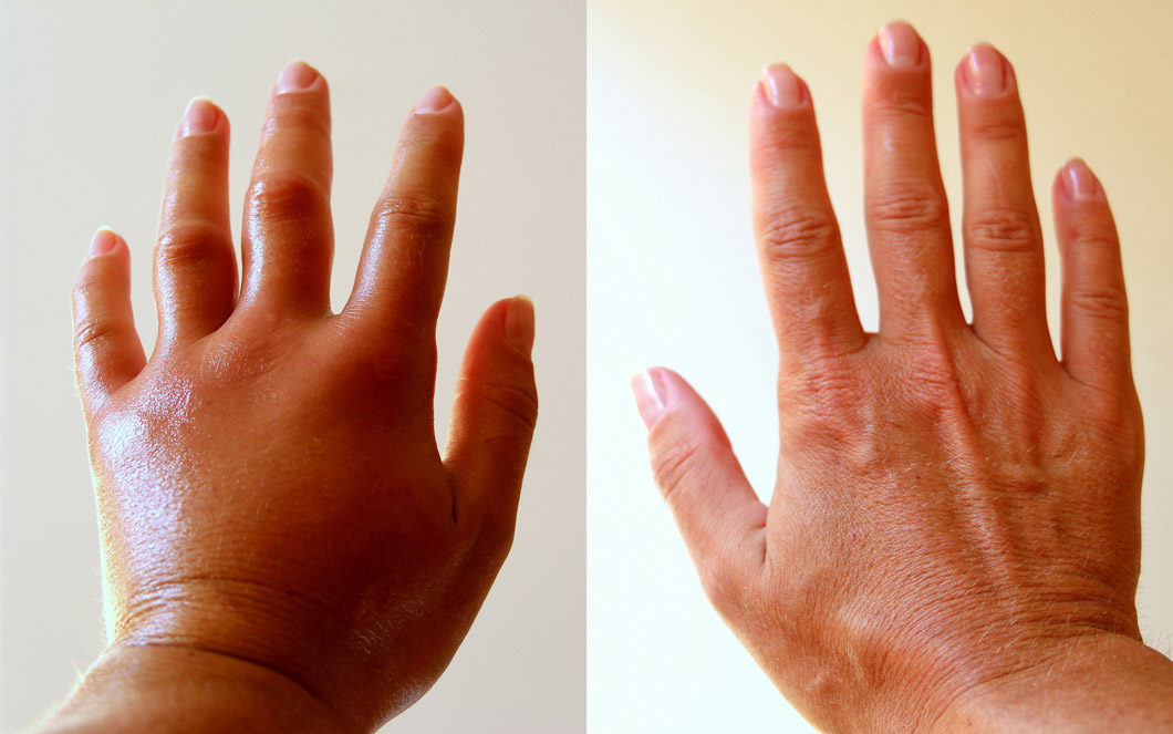 腕のリンパ浮腫の原因と改善法