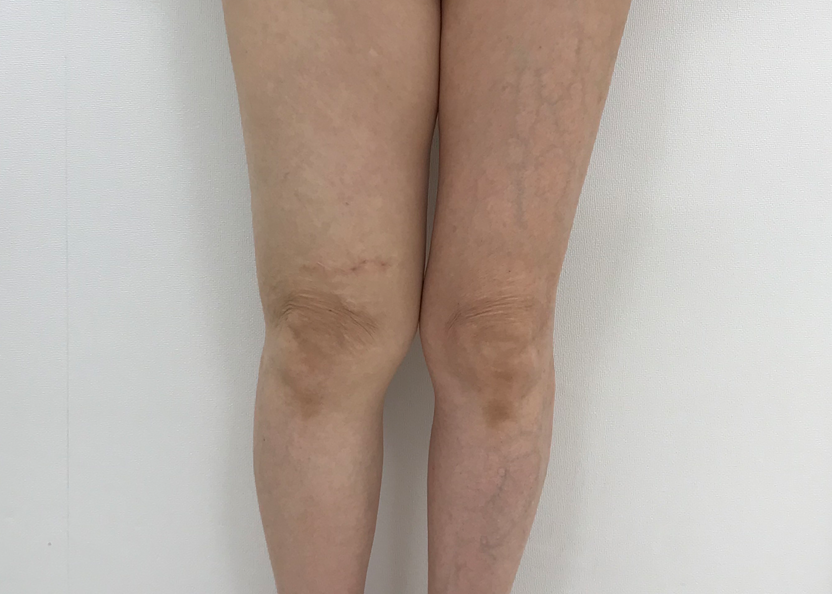 術後の患者様の正面お写真