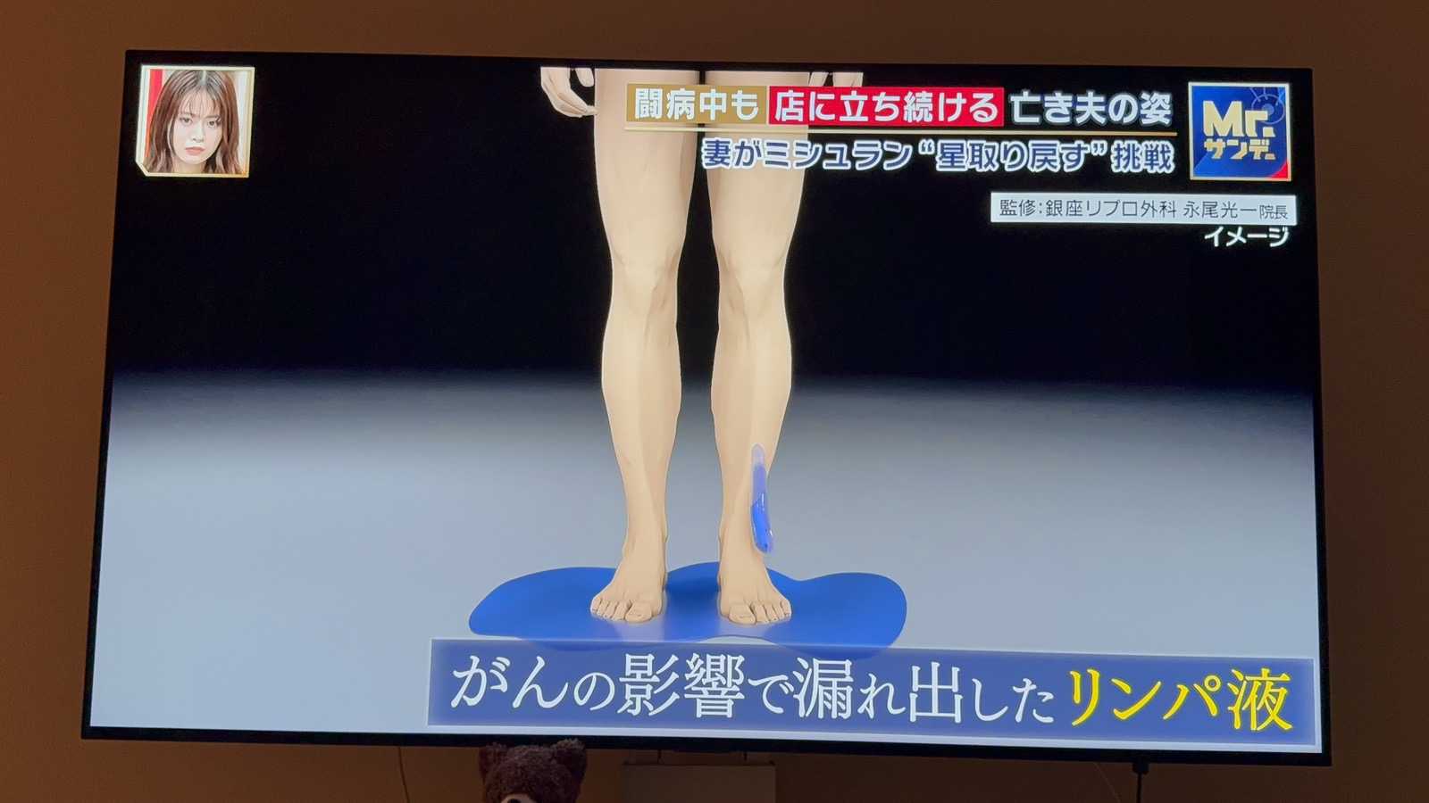 2025年8月17日放送フジテレビ「Mr．サンデー」にてリンパ漏について当院院長永尾光一がVTR監修いたしました